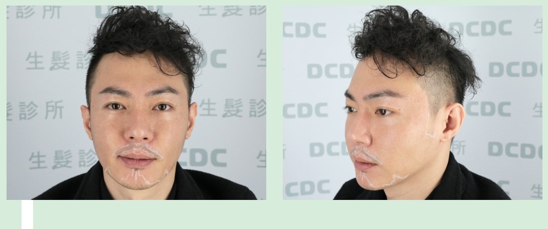 DCDC專業植鬍與植鬢角FUE術前稀疏